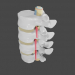modèle 3D de Protrusion et hernie dans la colonne lombaire acheter - rendu