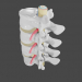 modèle 3D de Protrusion et hernie dans la colonne lombaire acheter - rendu